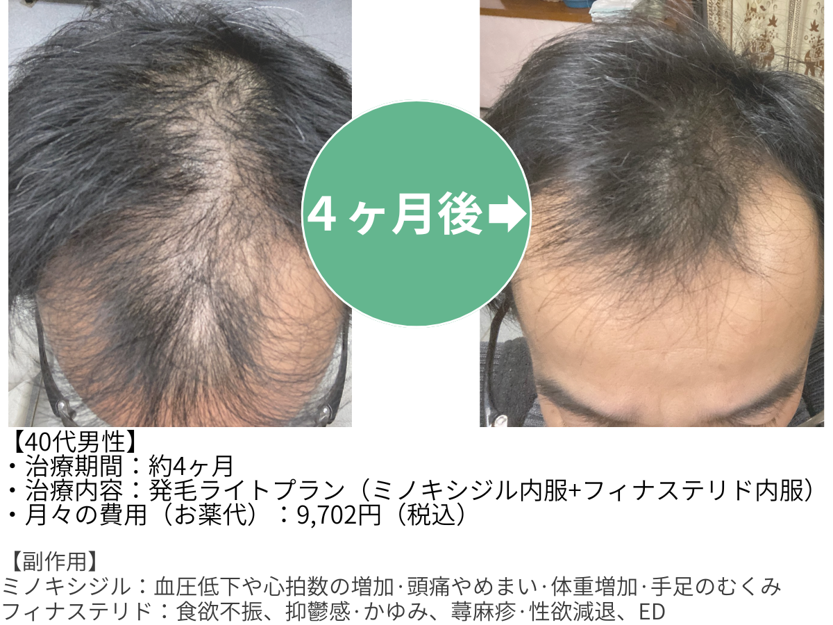 クリニックフォアの発毛プラン利用者の症例画像