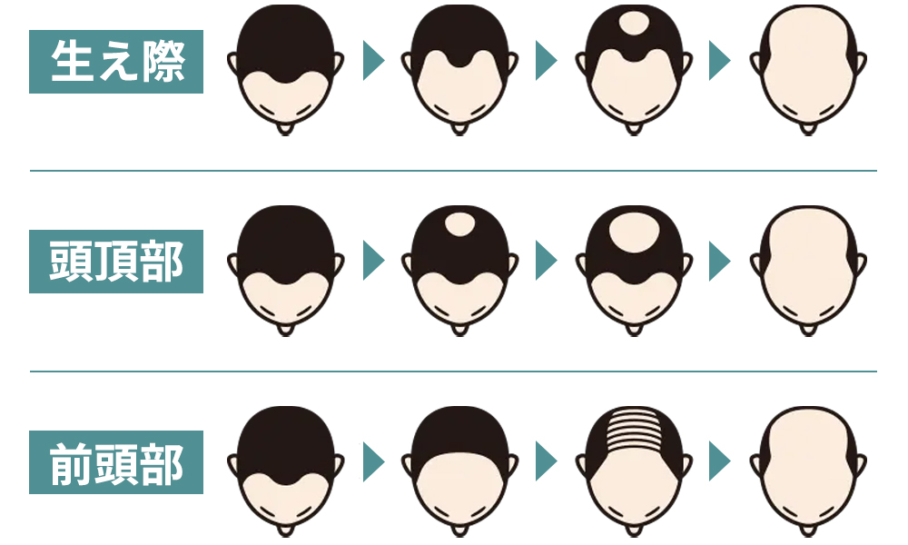 AGA進行イメージ。AGAはどれだけ早く治療を始めるかが重要